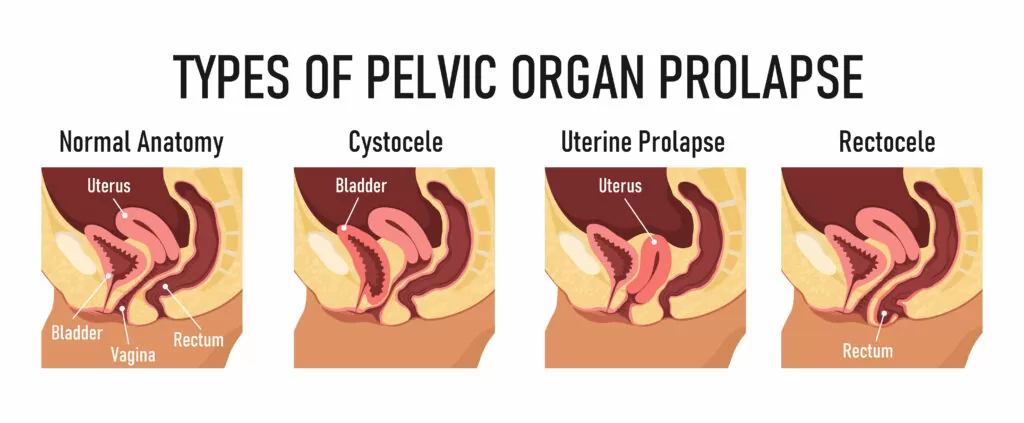 types of pelvic organ prolapse